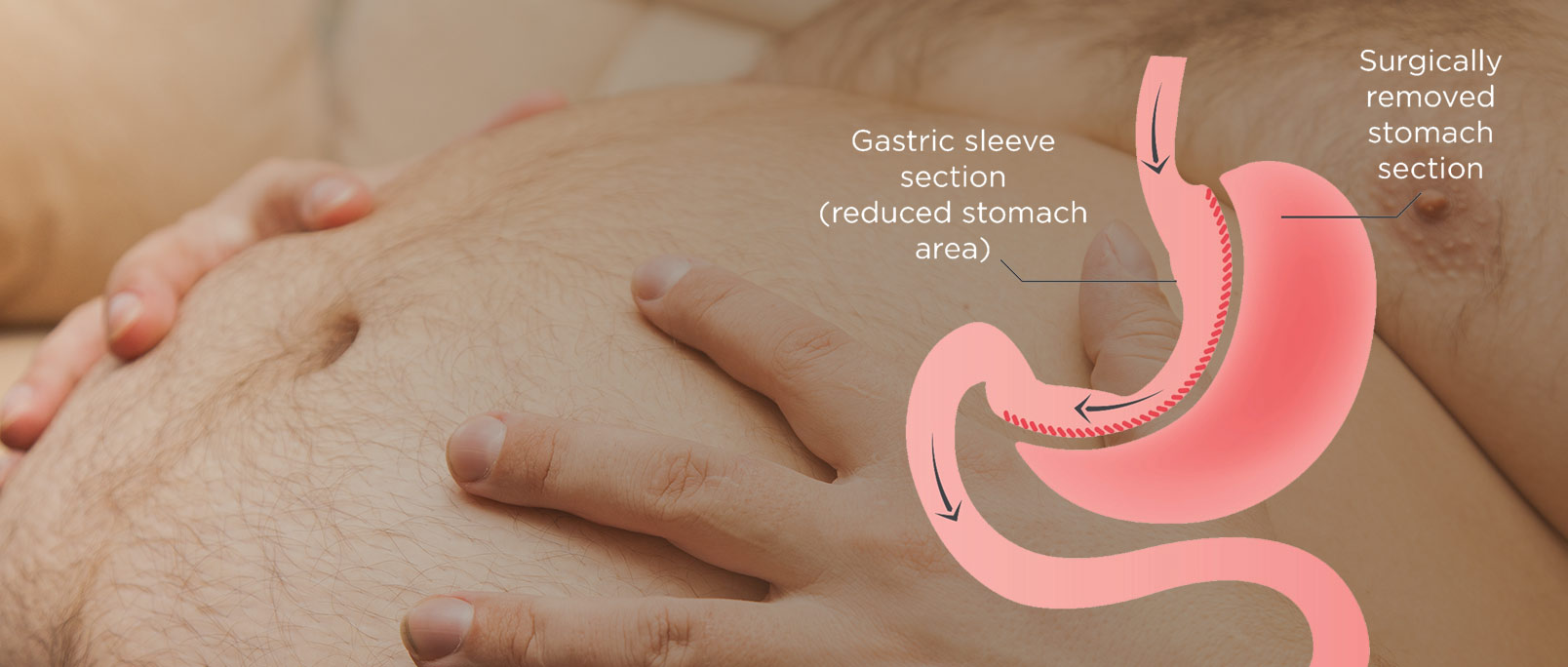 Gastric-Sleeve-Surgery