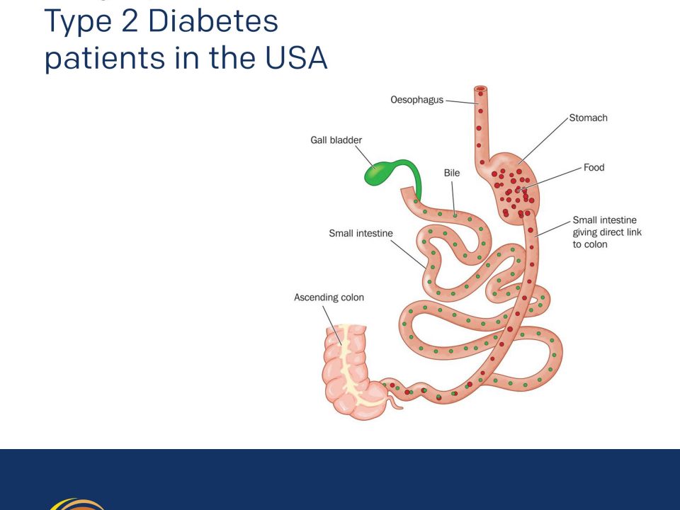 Duodenal Switch Surgery for Type 2 Diabetes patients in the USA